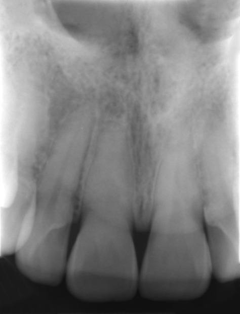 RADIOGRAFIA PERIAPICAL