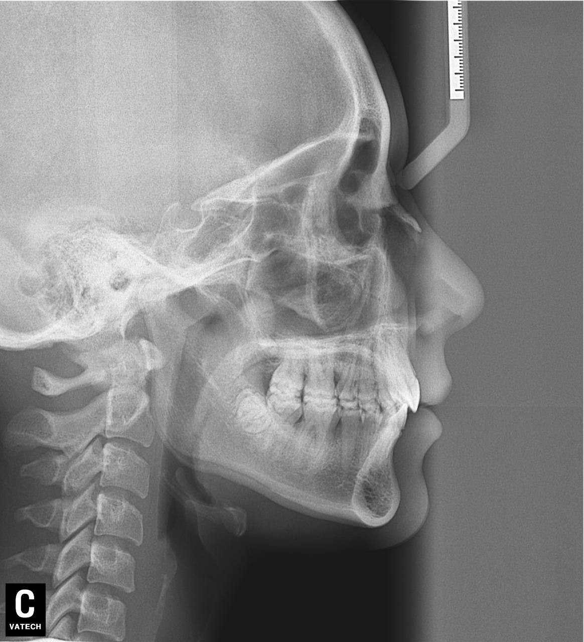 TELERRADIOGRAFIA EM NORMA LATERAL