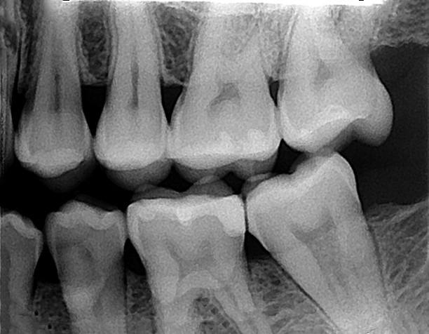 RADIOGRAFIA INTERPROXIMAL